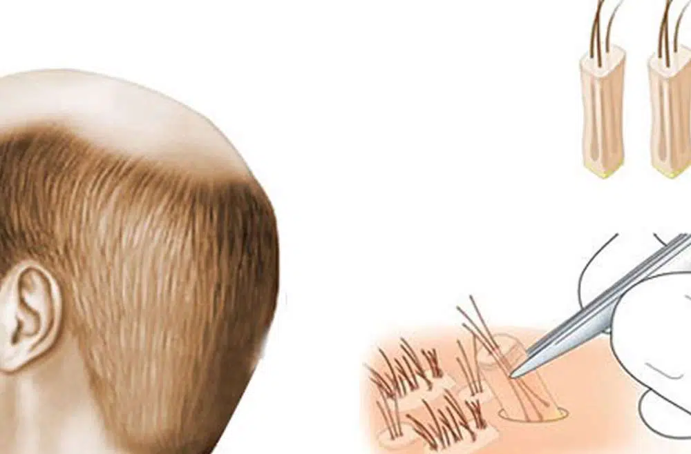 Hair Transplant Allahabad, Expert Surgeon, Low Cost, Best Result