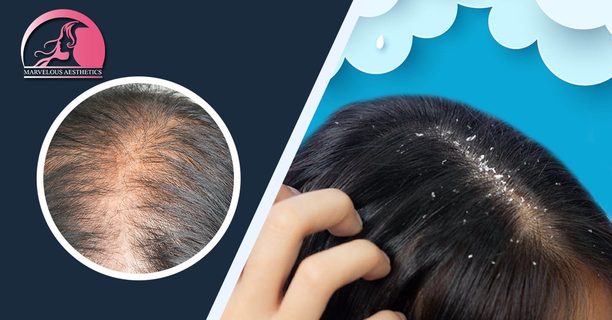 Is It Possible for the Monsoon to Cause Dandruff, Scalp Infections, and Hair Loss?
