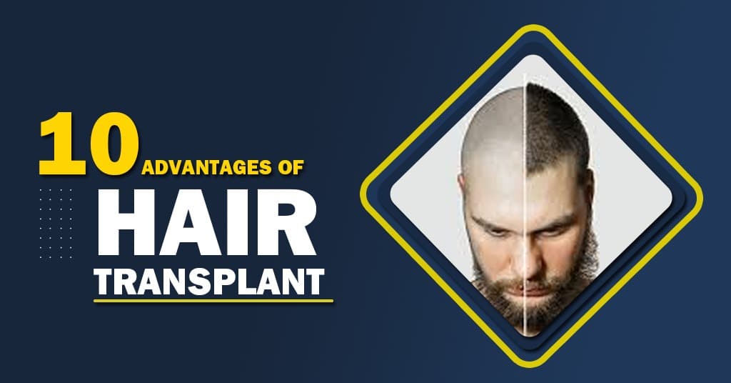 10 Advantages of Hair Transplant