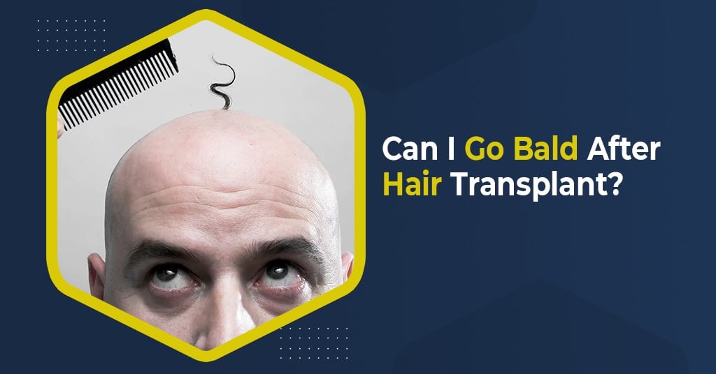 Can I Go Bald After Hair Transplant