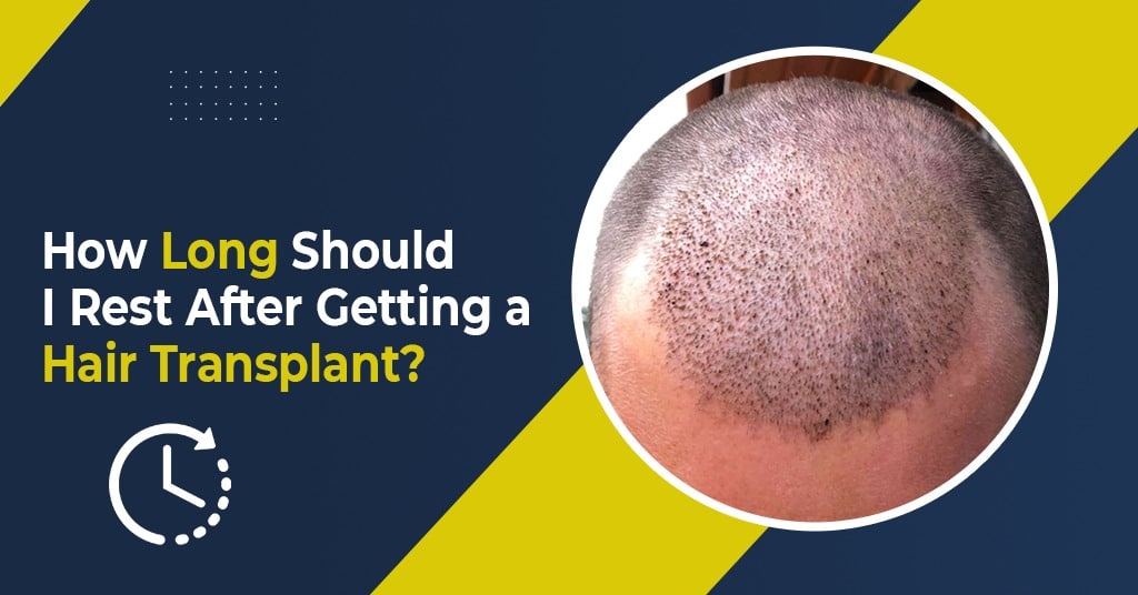 how-long-should-i-rest-after-getting-a-hair-transplant-marvelous