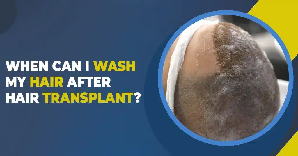 When Can I Wash My Hair After Hair Transplant?