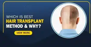 Which is Best Hair Transplant Method & Why?