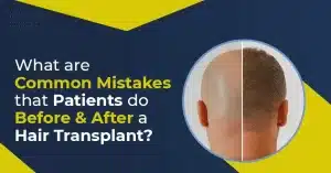 What are common mistakes that patients do Before and After a Hair transplant?
