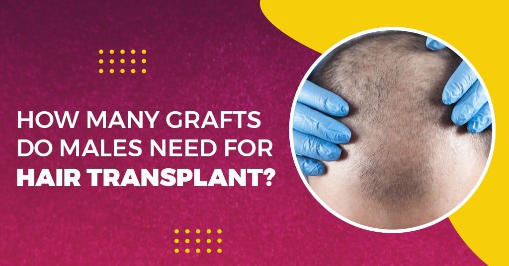 How Many Grafts do Males need for Hair Transplant?