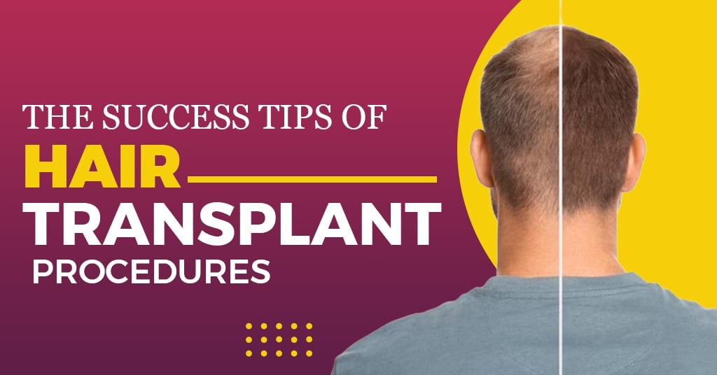 The Success Tips of Hair Transplant Procedures
