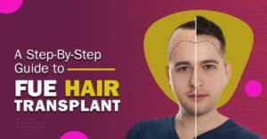 A Step-by-Step Guide to FUE Hair Transplants