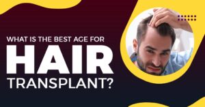 What is the Best Age for Hair Transplant?