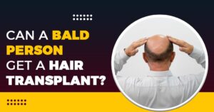 Can a Bald Person get a Hair Transplant?